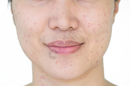 亚洲妇女激光治疗的面部和颈激光处理器皮肤雀斑和黑暗点产生的烧或沙巴亚洲人年龄医疗的图片