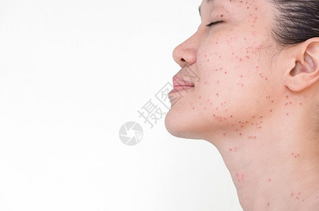 亚洲妇女激光治疗的面部和颈激光处理器皮肤雀斑和黑暗点产生的烧或沙巴面部的结痂年轻图片