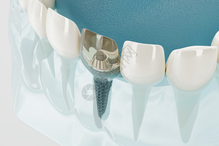 植入物牙科器的密闭组件透明3D转换药物安装图片