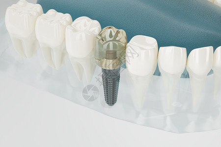 建成牙科植入器的密闭组件透明3D转换渲染支持的图片