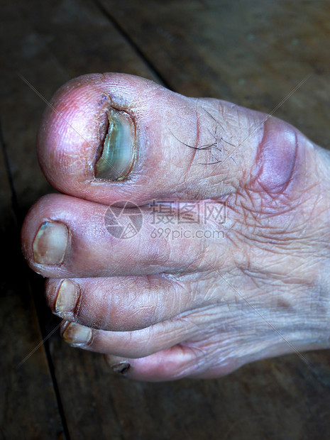 脚指甲健康事故在社会中辛勤工作的男人脚足为家庭安康提供生活耐心和命的流血福利感染图片