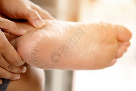 皮肤科治疗擦脚霜应定期施用按摩高跟鞋使奶油吸收水井帮助将分添加到脚皮上b提高水分图片