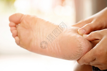 裂缝医疗的干旱脚霜应定期施用按摩高跟鞋使奶油吸收水井帮助将分添加到脚皮上b提高水分图片