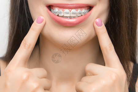 卫生快乐女嘴里的牙套美白后用两根手指在牙齿上的托槽显示自锁式托槽带有金属系和灰色松紧或橡皮筋可实现完美笑容正畸牙齿治疗快乐女嘴里图片