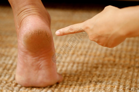 脚霜应定期施用按摩高跟鞋使奶油吸收水井帮助将分添加到脚皮上b提高水分丑陋干燥足病学图片
