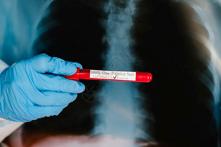 持有放射胸部X光片的医生专科肺学家用于对受感染的冠状动脉进行人健康医疗诊断的抗放射胸部X光片A手拿着带有生物样本血液的试管X射线图片