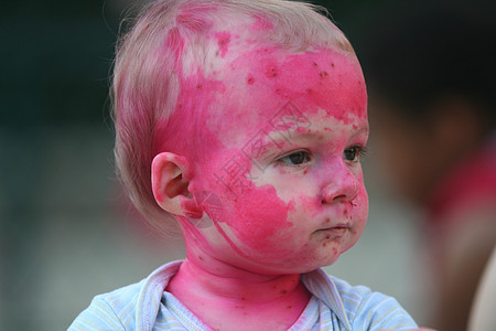 儿童申诉童年皮肤婴儿男生疾病图片