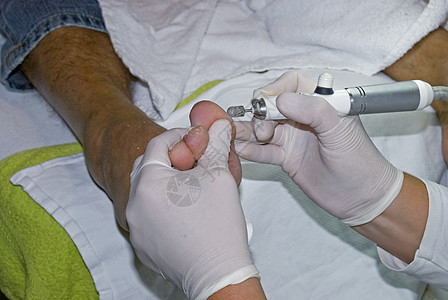 切除硬皮温泉毛巾反射病人治疗护理卫生指甲美容师脚趾图片
