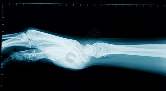 手腕X光外科女性生物学医生三角骨电影手指舟骨指骨诊断图片