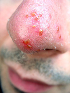 鼻鼻子冷酸宏观感染疾病发烧状况疼痛晒斑痛苦皮肤科结痂图片