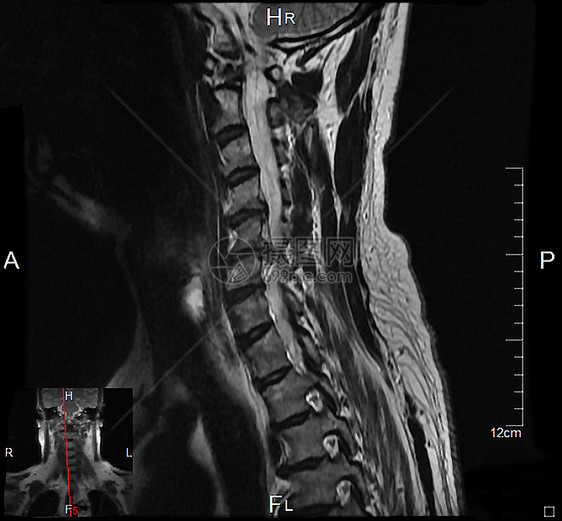 磁共振成像系列神经元麝香健康核磁共振捷运颈椎病神经身体乐队颈椎图片