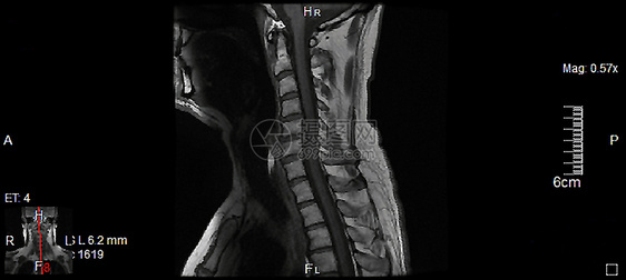 磁共振成像系列乐队辐射黑色器官身体颈椎神经元神经药品颈椎病图片