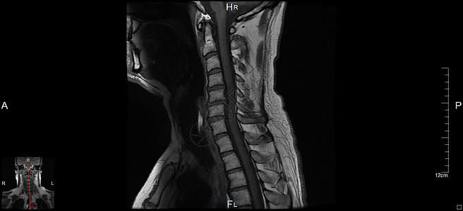 磁共振成像系列核磁共振颈椎器官神经元麝香颈椎病健康神经乐队药品图片
