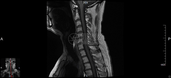 磁共振成像系列核磁共振颈椎器官神经元麝香颈椎病健康神经乐队药品图片