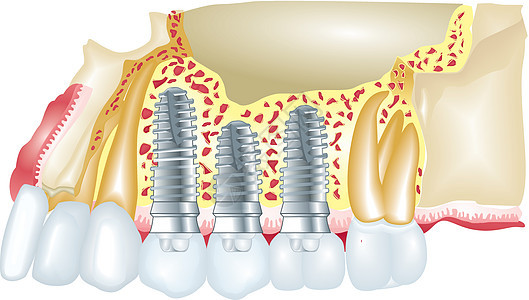 牙科移植程序外科医院医师牙齿牙龈螺丝植入物医疗手术图片