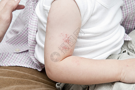 儿童臂中的疹子手臂治疗皮肤科婴儿痛苦透明带感染病理疾病结痂图片