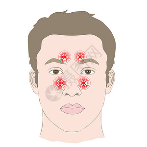 头痛 疾病鼻炎感染图片