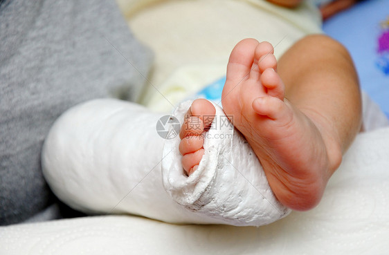 在绷带和石膏中婴儿脚夹板男生水平保健卫生医疗骨科照片图片