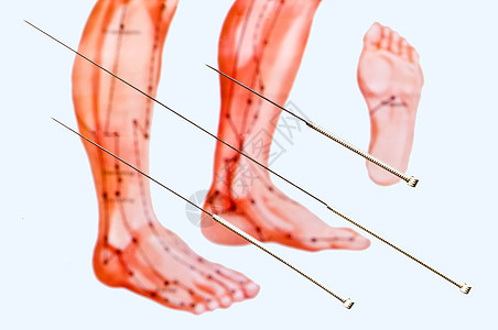 针刺针治疗医疗药品康复中医治愈治愈者图片
