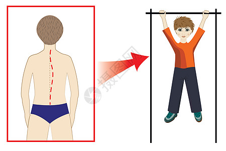 脊髓弯曲预防图片