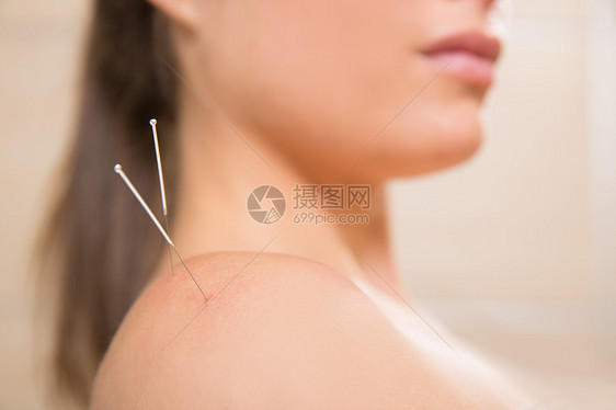 针缝针刺在妇女肩上女士药品幸福肩膀技术治疗临床压力福利针灸师图片
