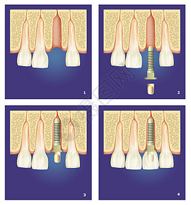 牙科假牙外科冠军光标夹钳牙疼操作刀刃切口麻醉假肢图片