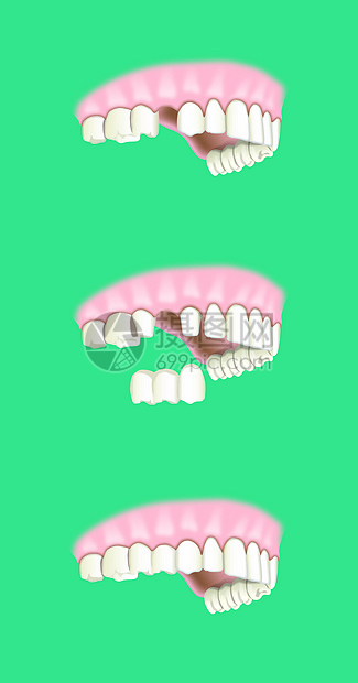 牙科假牙植入术图片