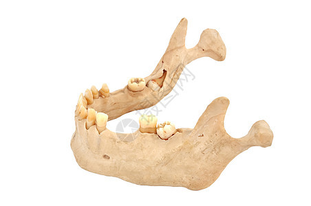 下颌假肢保健卫生牙科树桩塑料牙齿牙周口腔科臼齿图片