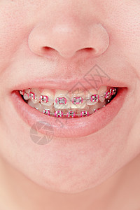 牙科概念打扫牙医嘴巴矫正医疗设备青少年牙齿微笑女孩们图片