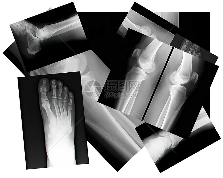 人体腿骨X光片辐射渗透骨骼脚趾摄影生理电影公用事业射线治疗图片