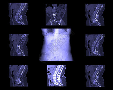 计算脊椎断层造影手术脊柱库存骨头诊断疾病照片身体铁饼髓质图片