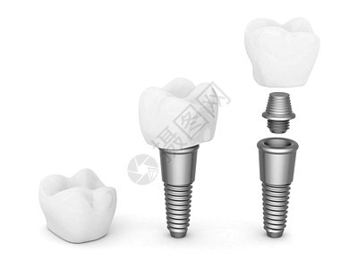 牙科移植插图医疗合金治疗金属牙医技术白色别针手术图片