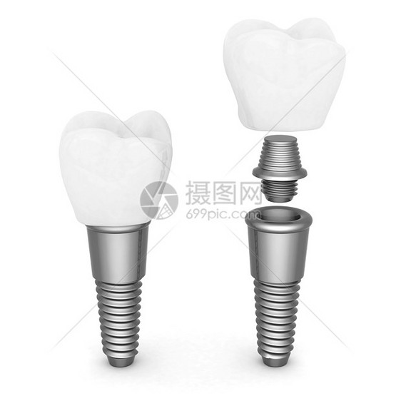 牙科移植药品医疗牙医搪瓷金属白色假牙别针插图技术图片