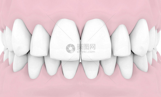 牙科移植白色假牙外科技术合金别针搪瓷牙医医疗凹痕图片