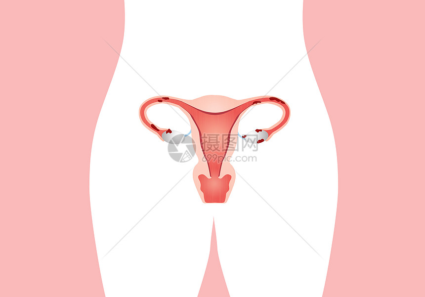 子宫内硬化疾病黄弓丝带粉色保健药品排卵卫生预防疼痛图片