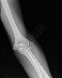手臂X射线x光男性成人解剖学技术射线药品诊所病人身体图片