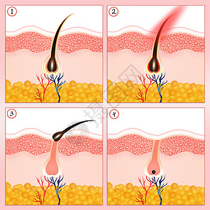 永久脱发毛细管沙龙休息卵泡黑色素表皮脱毛损失皮肤科美丽图片