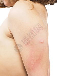 肩膀左臂有蜂窝 皮疹或某些皮肤异常的儿童图片