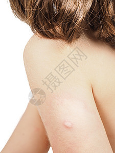 有蜂窝 皮疹或某些皮肤异常的儿童蚊子金发疫苗皮肤科蜜蜂蜂巢感染过敏控制结核图片