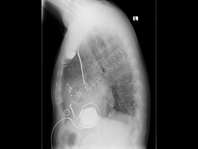 射线 胸部 心脏起搏器健康假肢解剖学诊断调查感染病人移植电池预测图片