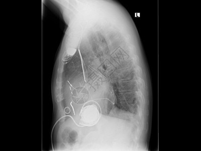 射线 胸部 心脏起搏器解剖学健康人体压力心肌病人涡轮移植辅助疾病图片