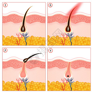 摘除头发理发沙龙黑色素无毛脱毛真皮休息皮肤科生长美丽乳突图片