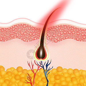 摘除头发理发毛细管皮肤科无毛损失黑色素表皮休息脱毛美丽真皮背景图片
