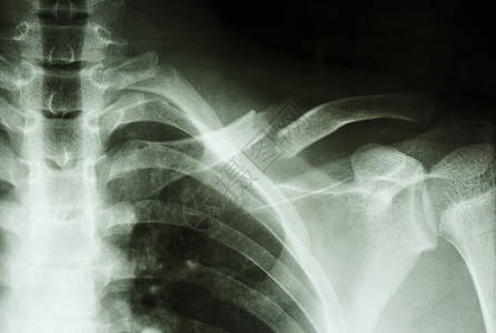 左颈骨折医院科学临床医师药品疾病考试病人身体骨骼图片