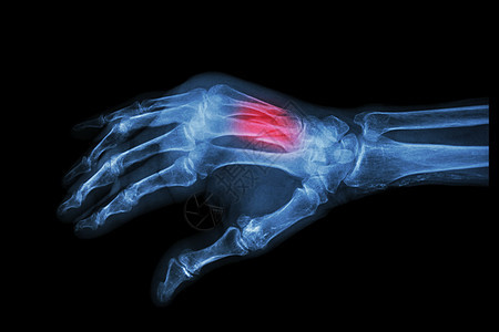 第三和第四代骨骨骨折断手腕骨骼外科疾病医生x光放射科电影腕骨前臂图片