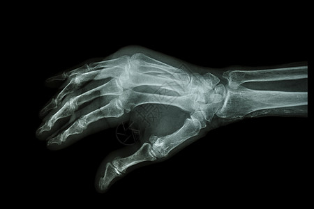 第三和第四代骨骨骨折断碰撞电影创伤保健手臂蓝色放射科棕榈前臂倾斜图片