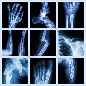 采集骨骨折弯头手臂疾病诊断情况x射线手指前臂外科碰撞图片
