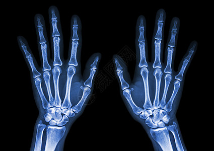 人的正常手诊断x射线放射科临床医院骨科疾病手臂身体男人图片