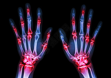 多关节淋巴 风湿的人体手和关节炎手腕保健病人骨骼电影棕榈骨科痛风卫生蓝色图片