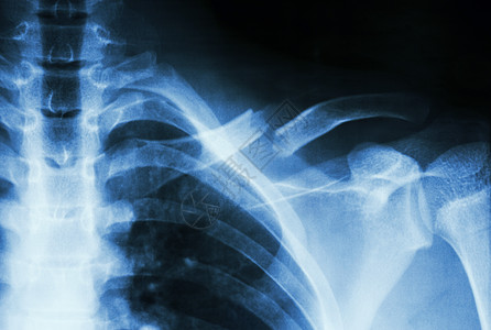 左颈骨折肩膀解剖学x射线药品治疗射线卫生医生胸部骨骼图片